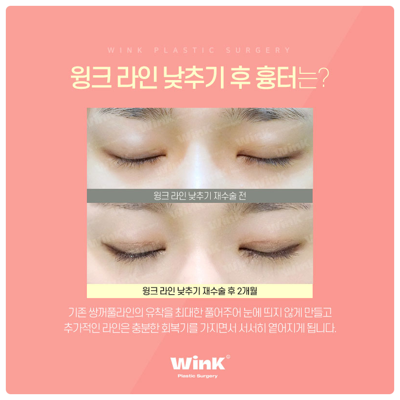소세지눈재수술 서울눈재수술 눈재수술병원 알아본다면 윙크성형외과 관련 이미지 5