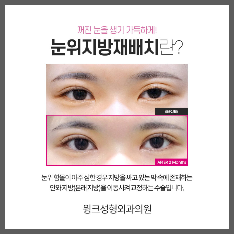 눈위 지방재배치에 대해 알아보겠습니다. 관련 이미지 2