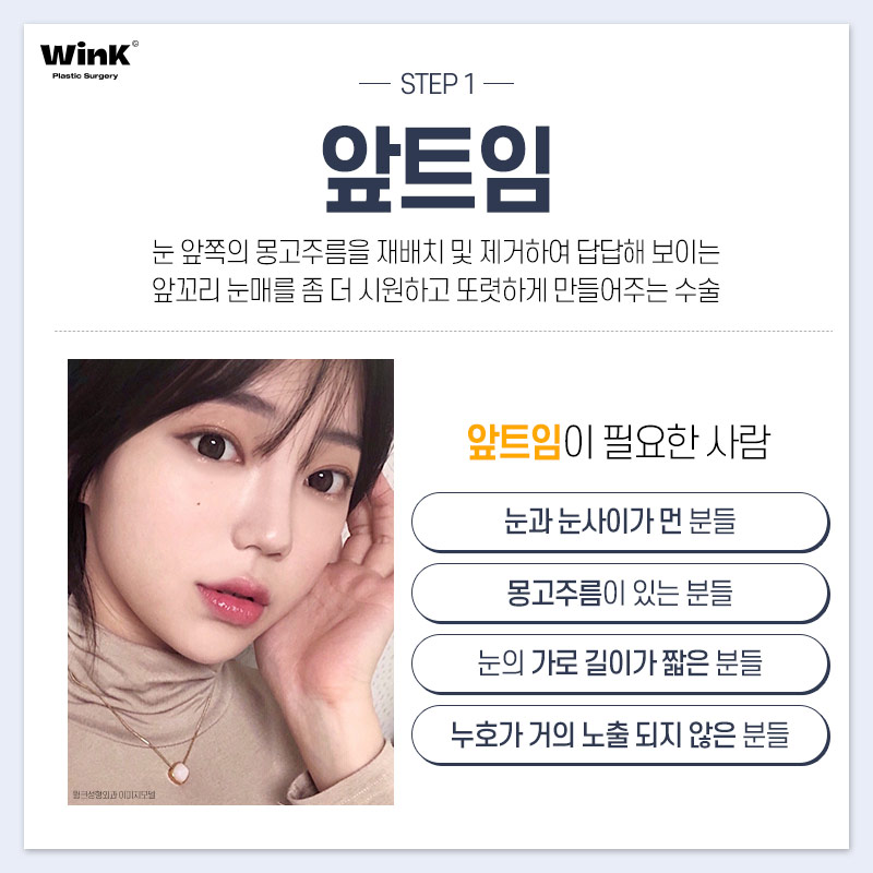 윙크성형외과에서 추천하는 눈 유형별 트임 성형? 관련 이미지 3