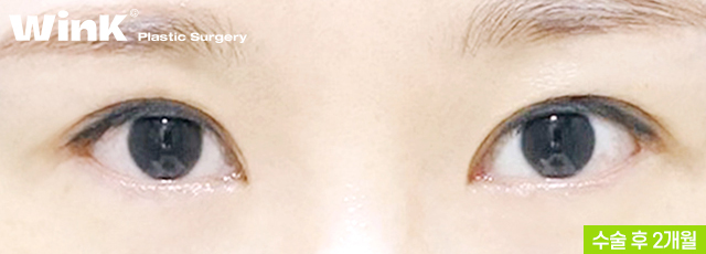 Thick Double Eyelids, “Sausage Eyes.” Let’s Improve Them Naturally with Wink’s Double-Incision Double Eyelid Revision Surgery! image 9