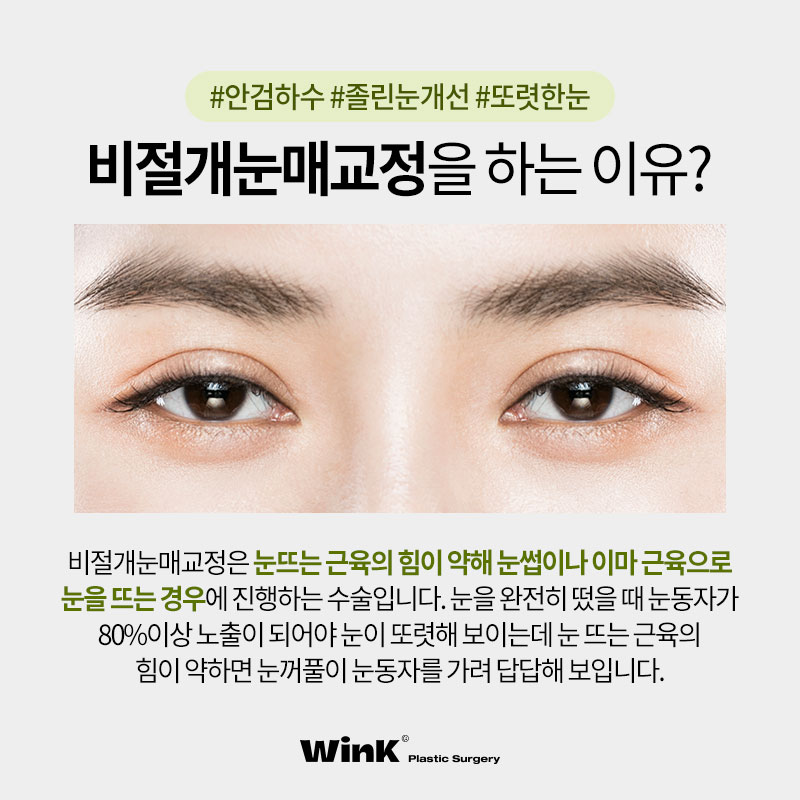 Improvement for Sleepy Eyes? Get Clear, Refreshing Eyes with Non-Incisional Eye Correction at Wink Plastic Surgery! image 2