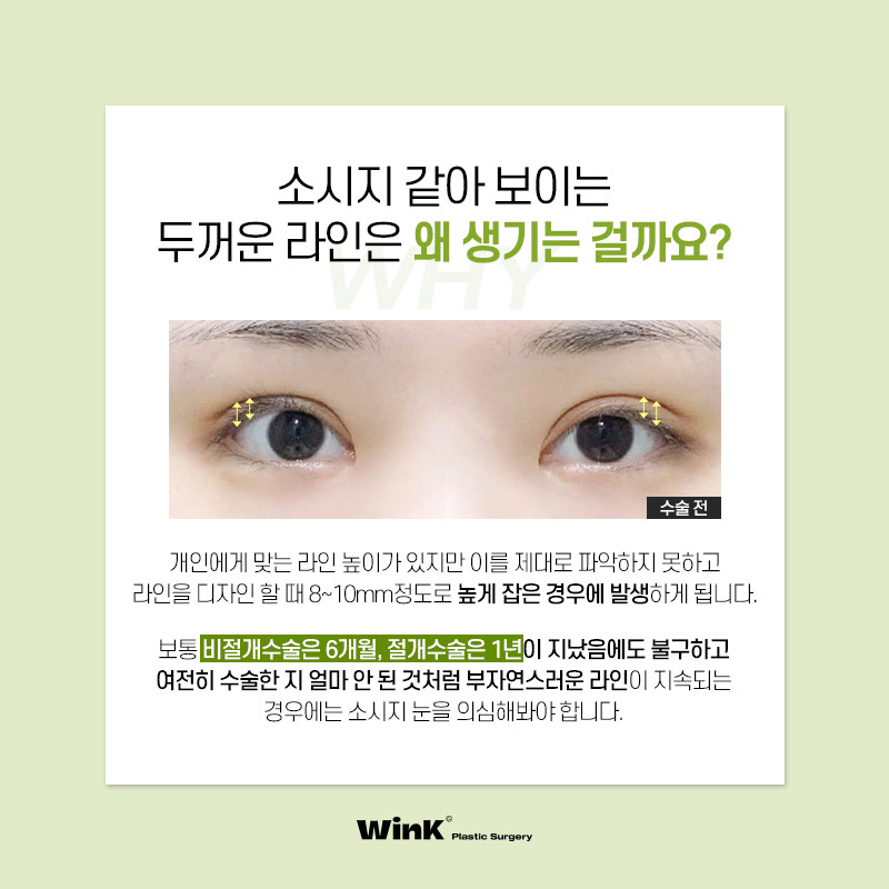 Thick Double Eyelids, “Sausage Eyes.” Let’s Improve Them Naturally with Wink’s Double-Incision Double Eyelid Revision Surgery! image 2