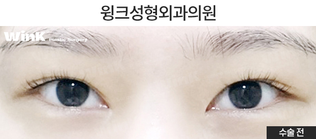 꼬막눈 쌍수도 시원하게! 눈성형 중점 진료 윙크성형외과 관련 이미지 2