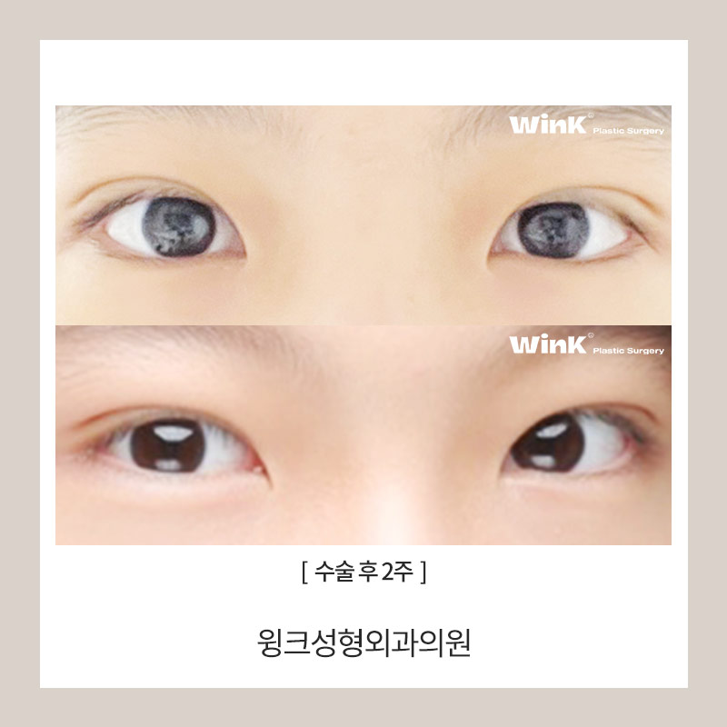 자연유착쌍수후기 자연유착전후를 알아본다면 윙크성형외과가 정답! 관련 이미지 4