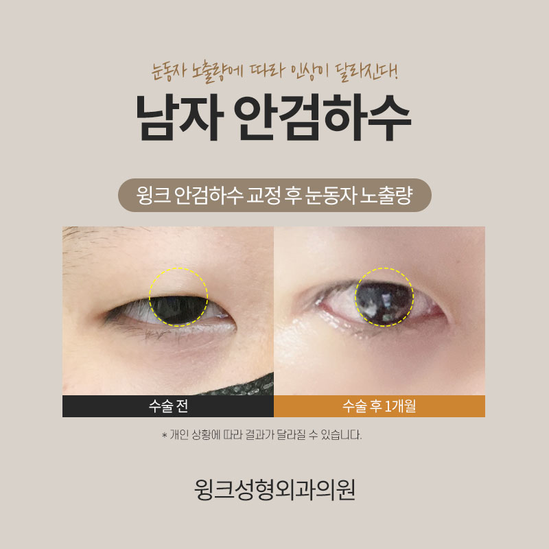 남자 안검하수 교정에 관해 알아보겠습니다. 관련 이미지 3