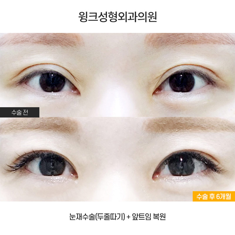 Turning a Thick Outer-Line Double Eyelid into a Natural Inline Through Double-Fold Revision image 1