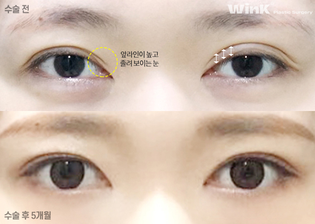 두줄따기 절개 눈재수술로 소세지눈에서 벗어나 볼까요? 관련 이미지 7