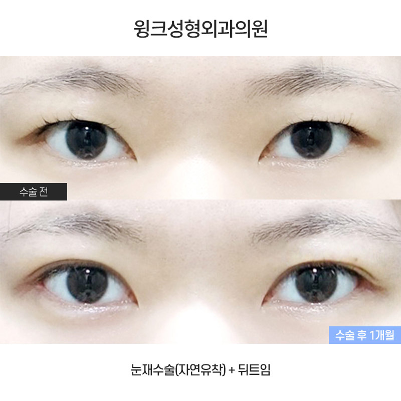 What Are the Important Factors for Successful Revision Eye Surgery? image 1