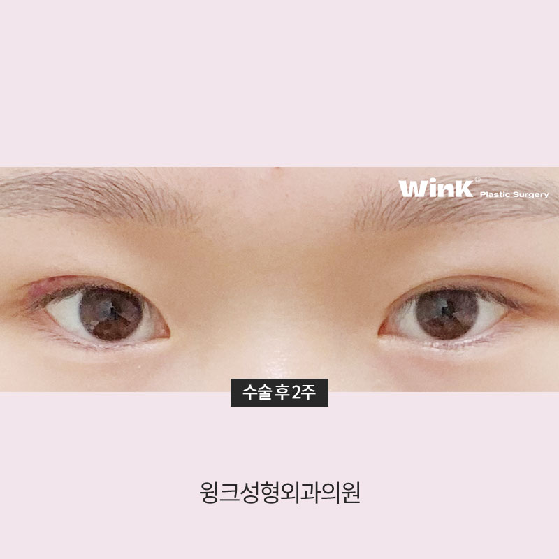 A Natural Line That Looks Just Like Your Original Eyes: In-line Double Eyelids image 8
