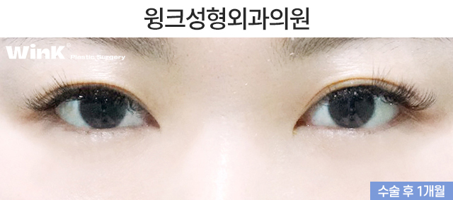 Lower Eyelid Fat Repositioning: Who Is It Effective For? image 3