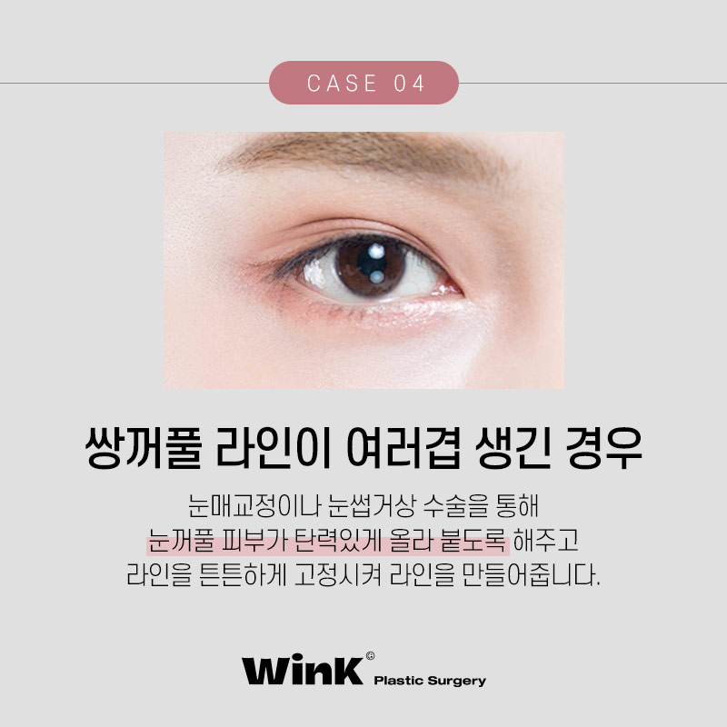 소세지눈재수술 생각한다면? 윙크성형외과 신사역쌍꺼풀재수술 관련 이미지 6