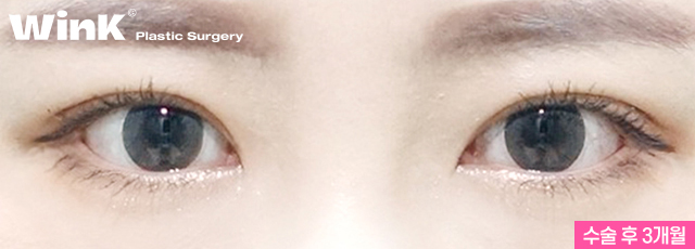 Fast Return to Daily Life and Natural Lines with Wink Natural Adhesion! image 4
