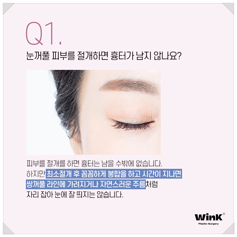 처진눈꺼풀수술 눈처짐수술 알아본다면 윙크성형외과 상안검수술 상안검수술회복기간 관련 이미지 2