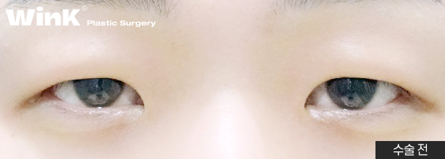 Does He Look Sleepy Because of Ptosis? At Wink Plastic Surgery, Get a Natural and Refreshed Eye Shape! image 3