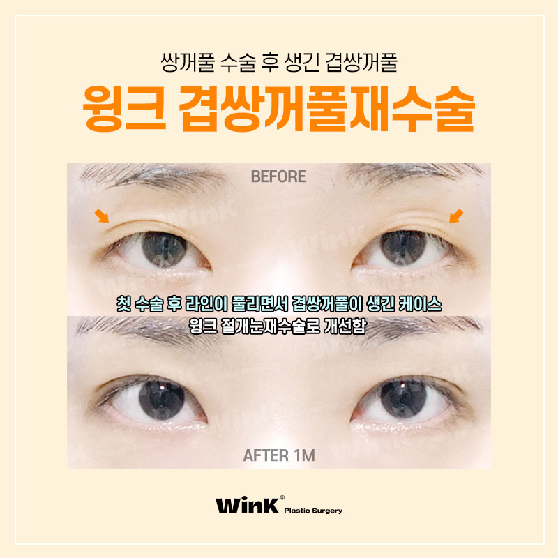 Double Eyelid Surgery Left You with a Double Fold? Fix It Neatly with Revision Surgery for Double Folds at Wink Plastic Surgery! image 3