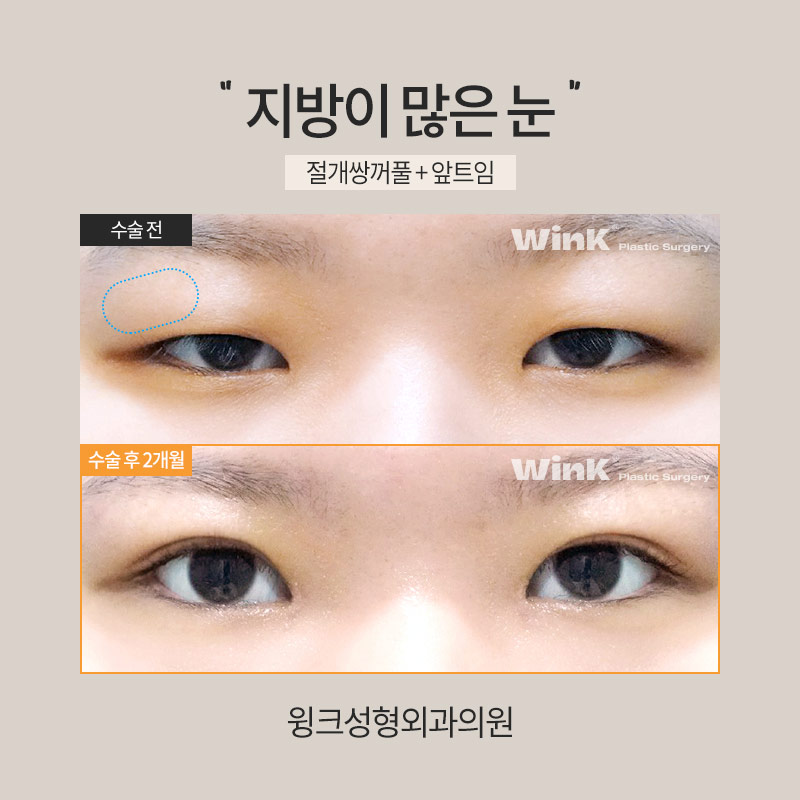 How Is Double Eyelid Surgery Performed on Eyes with a Lot of Fat? image 4