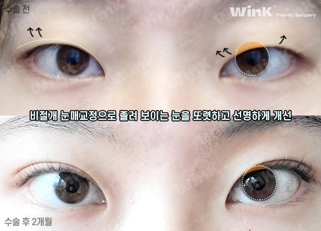 남자 속쌍커풀 수술에 대해 알아보자 관련 이미지 7