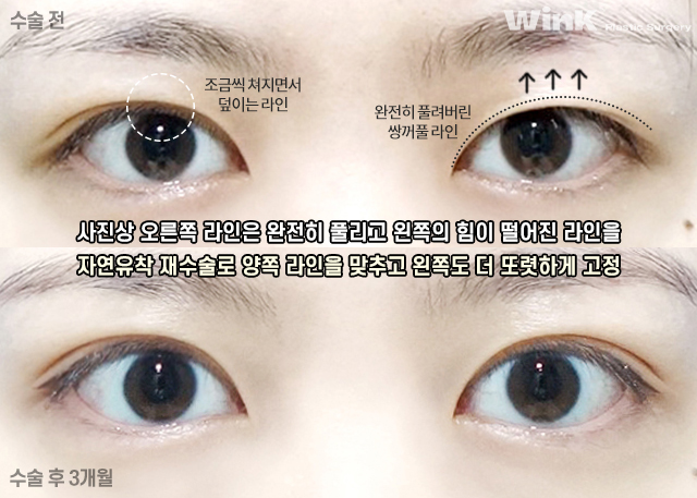 Shall We Take a Look at the Symptoms of Double Eyelid Loosening? image 7