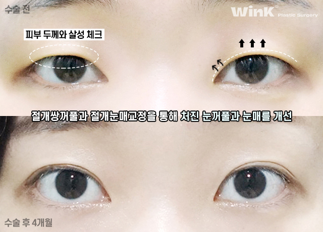 절개 눈매교정 쌍꺼풀 수술에 대해 알아볼까요? 관련 이미지 4