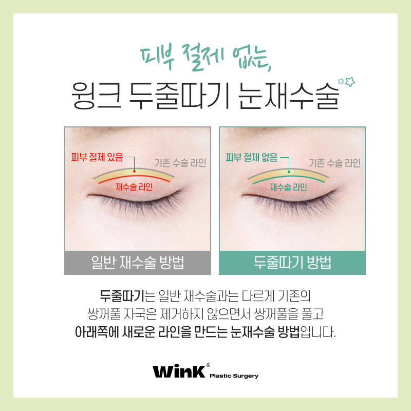 두꺼운 소세지눈? 윙크성형외과 두줄따기 눈재수술로 라인낮추기! 관련 이미지 2