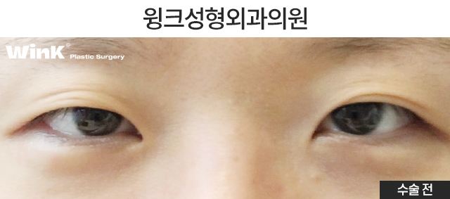 눈매교정의 효과에 대해 알아보겠습니다. 관련 이미지 5