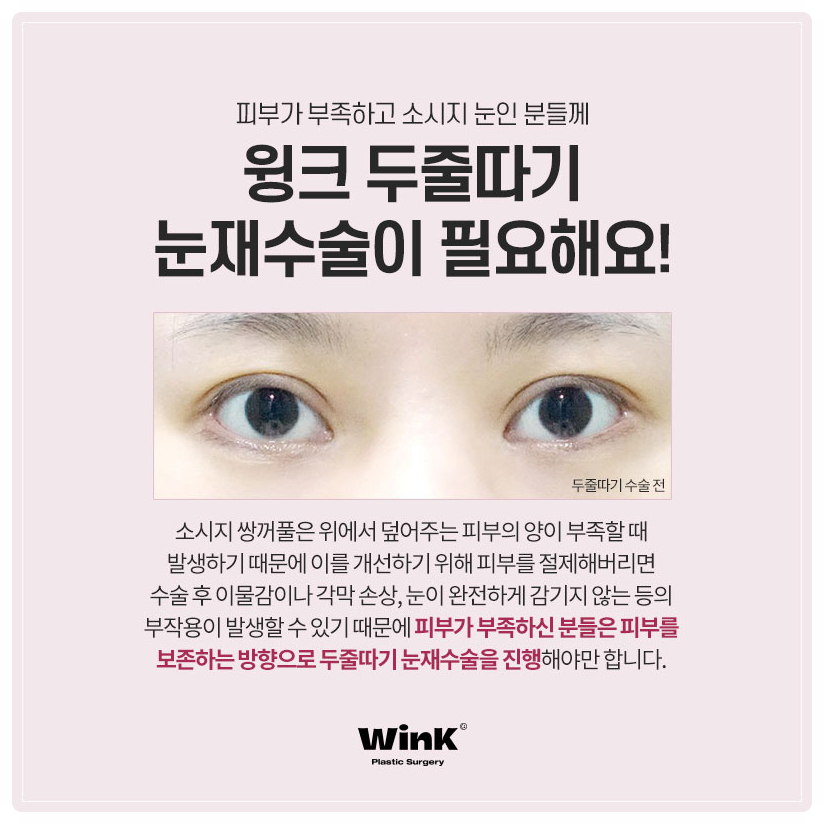 Revision Surgery for Sausage-Like Double Eyelids: Lowering the Double-Eyelid Line, Wink Plastic Surgery Sausage-Eye Revision Review image 5
