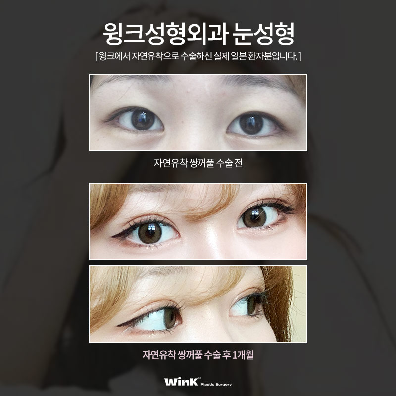 Coming to Korea from Japan for Plastic Surgery? WinK Plastic Surgery Explains the Japanese Double-Eyelid Line Preferred by Japanese Women! image 7
