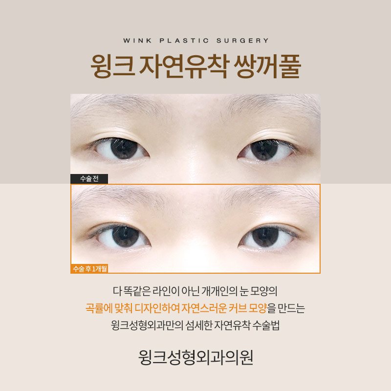 자연유착쌍수후기 자연유착전후를 알아본다면 윙크성형외과가 정답! 관련 이미지 2