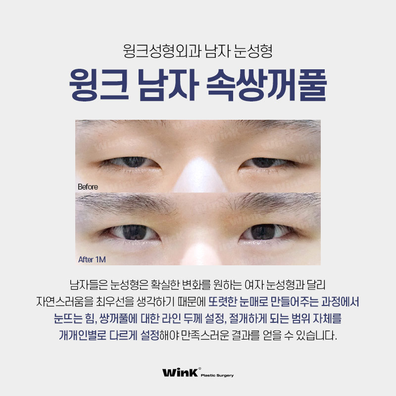 윙크성형외과만의 남자 눈성형으로 자연스럽게 호감형 이미지로 개선! 관련 이미지 7