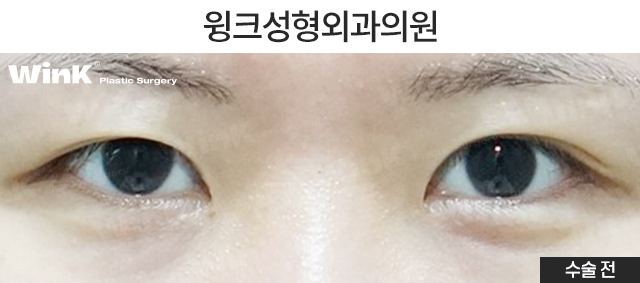 비대칭 안검하수 눈매교정은 어떻게 하는 것일까? 관련 이미지 5