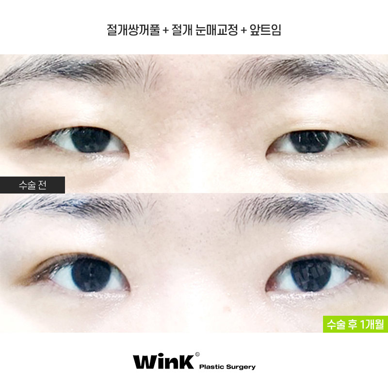 윙크성형외과는 절개쌍꺼풀 수술 후에도 빠르게 회복! 관련 이미지 1