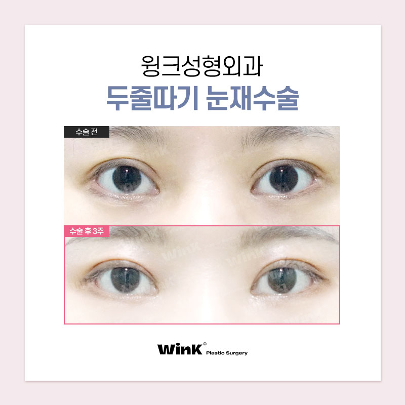 Thick, High Double Eyelid Lines and a Sausage-Like Eye! Solve It with Wink Double-Line Revision Surgery! image 6