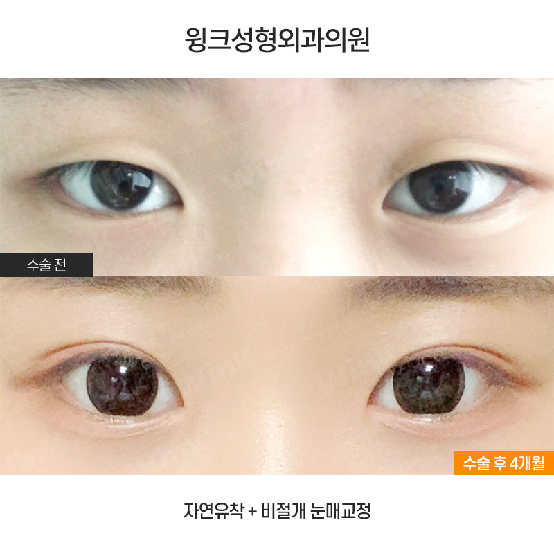 중학생 쌍커풀수술에 대해 알아볼까요? 관련 이미지 1