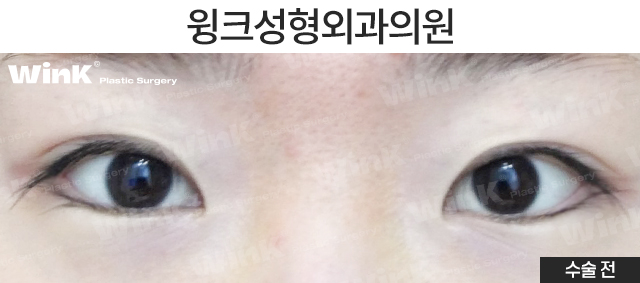 뒷밑트임으로 눈의 숨겨진 공간을 찾자! 윙크 듀얼트임 관련 이미지 2