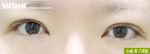 Are All Revision Eyelid Surgeries the Same? For High Crease "Sausage Eyes," Use Two-Line Technique to Lower the Front Line image 8