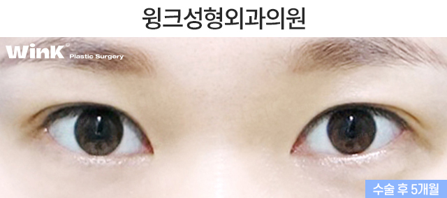 What Are the Important Factors for Successful Revision Eye Surgery? image 6