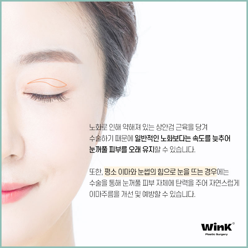 윙크성형외과에서 알려드리는 상안검에 대한 모든 것! 관련 이미지 7