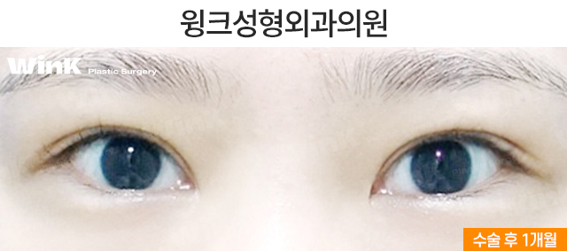꼬막눈 쌍수도 시원하게! 눈성형 중점 진료 윙크성형외과 관련 이미지 3