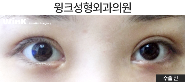 Make a Fierce Eye Shape Look Gentle with Outer and Lower Corner Eye Surgery! image 2