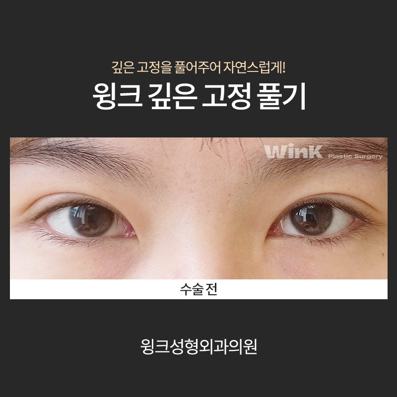 How Do You Release Deep Double Eyelid Fixation? image 5