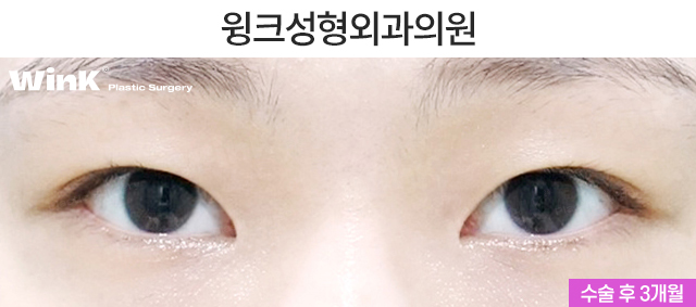 Let’s Learn About Before and After Natural Adhesion Double Eyelid Surgery image 6