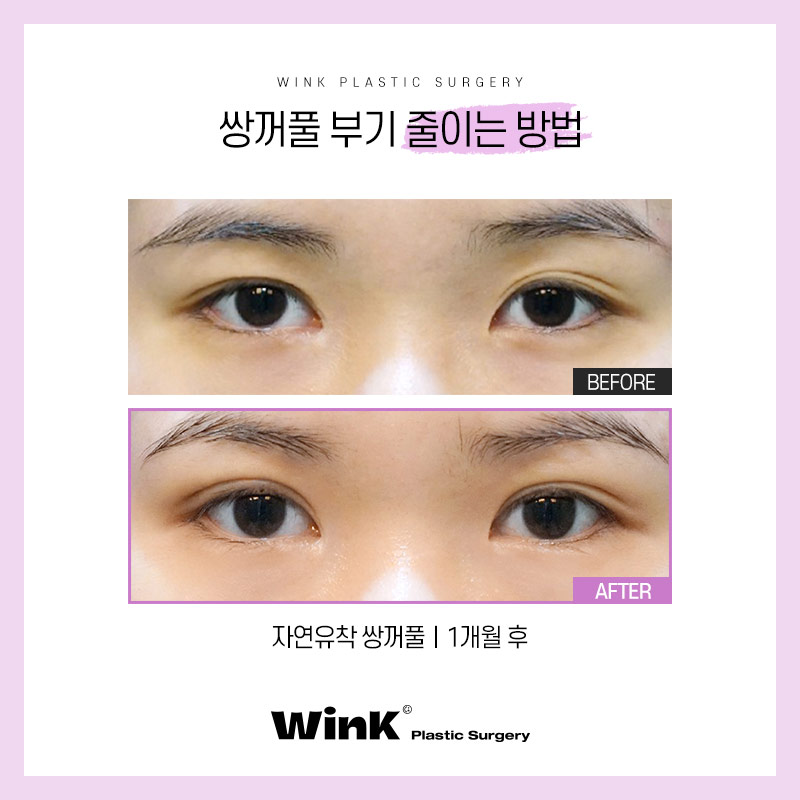 How to Reduce Swelling After Double Eyelid Surgery: Wink Plastic Surgery Explains! image 5