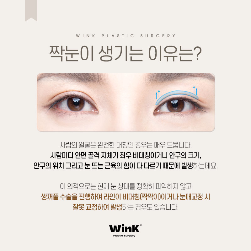 정확한 원인 파악과 적합한 수술 방법이 중요한 윙크성형외과 짝눈교정 관련 이미지 2