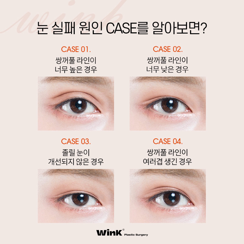 1차 수술 실패 원인 파악이 중요한 눈재수술, 윙크성형외과에서 정확하게 파악해 드려요! 관련 이미지 2