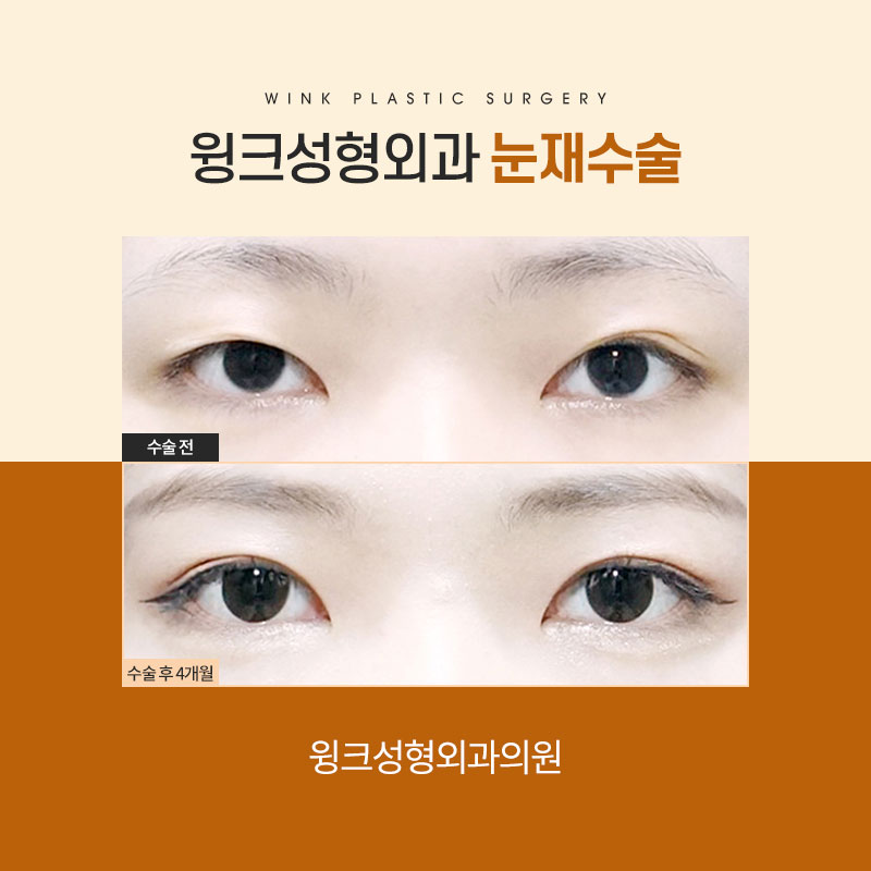절개쌍꺼풀 재수술 시 알아야 둬야 할 것은 무엇일까요? 관련 이미지 4