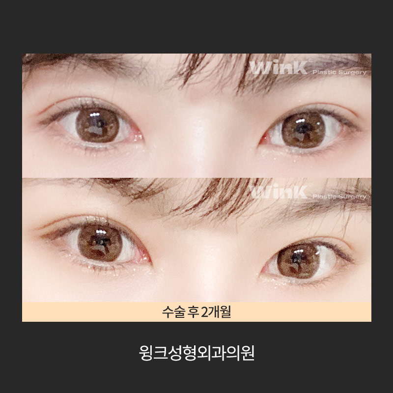 How Do You Release Deep Double Eyelid Fixation? image 7
