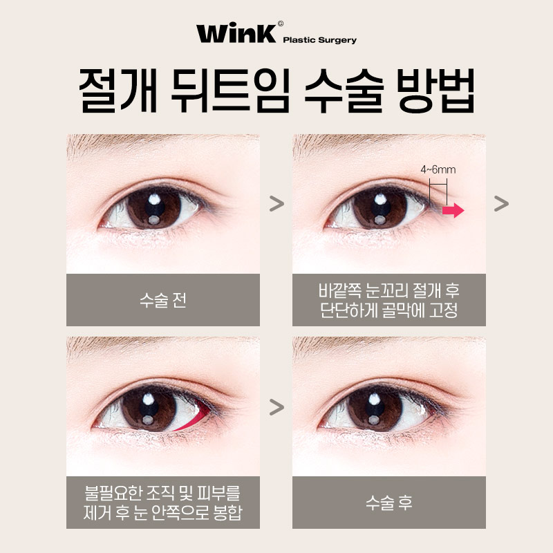 Elegant and Bright Eyes with Incisional Outer and Lower Canthoplasty at Wink Plastic Surgery! image 4