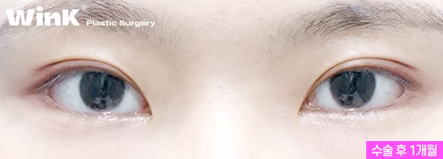 If you want to create the double eyelid line you want without being limited by your eye shape, Wink Incision Double Eyelid Surgery! image 9