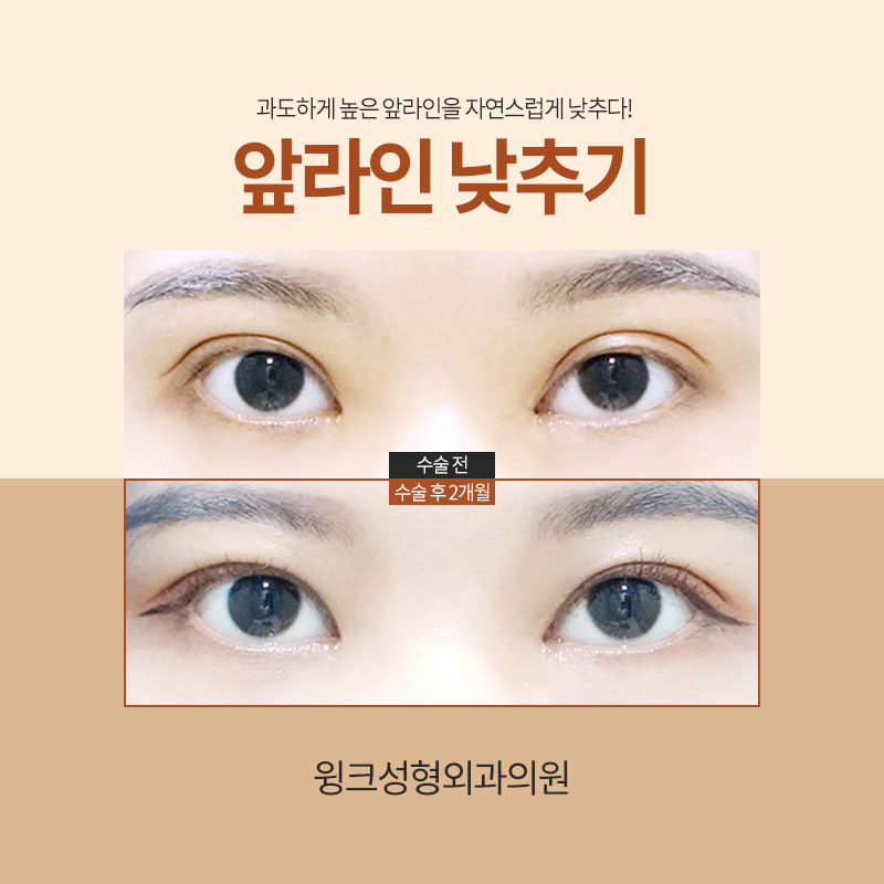 앞쪽이 두꺼운 아웃라인 쌍꺼풀, 해결 방법은? 관련 이미지 6