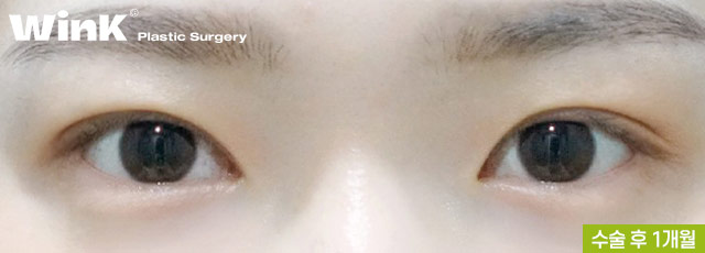 Non-incisional Eye Correction Review: A Natural, Clear Eye Shape! image 7